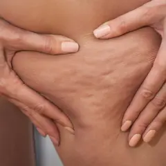 Dłonie ściskają skórę na udzie, ukazując cellulit. Szukasz sposobu, jak się pozbyć cellulitu?