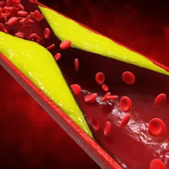 Złogi cholesterolu zwężają naczynie krwionośne, utrudniając przepływ krwi. Wysoki poziom homocysteiny może pogarszać ten stan.