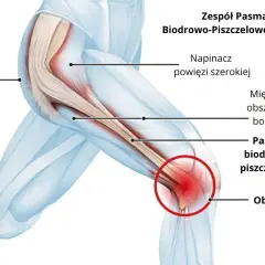 Anatomia kolana z zaznaczonym pasmem biodrowo-piszczelowym i obszarem bólu ITBS. Widoczny mięsień pośladkowy wielki i napinacz powięzi szerokiej.