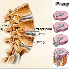 Przepuklina lędźwiowa: Jakie ćwiczenia pomogą, a czego unikać?
