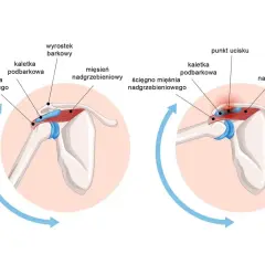 Anatomia barku: ścięgno mięśnia nadgrzebieniowego, kaletka podbarkowa i wyrostek barkowy. Po prawej widoczny punkt ucisku. Przedramię jest częścią kończyny górnej.