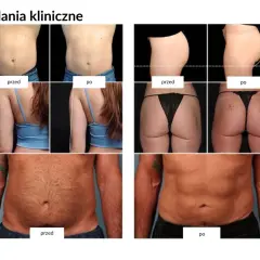 Badania kliniczne pokazują spektakularne trening ems efekty przed i po: szczuplejsze ciało, płaski brzuch i jędrniejsze pośladki.