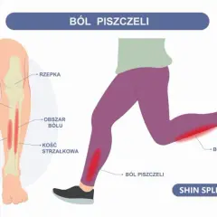 Ból goleni przy bieganiu: Twój przewodnik do biegania bez bólu