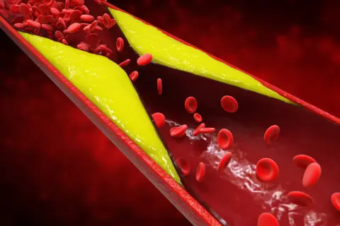 Złogi cholesterolu zwężają naczynie krwionośne, utrudniając przepływ krwi. Wysoki poziom homocysteiny może pogarszać ten stan.