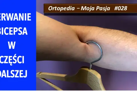 Zerwanie bicepsa w części dalszej. Widoczny hak wbit w mięsień, symbolizujący uraz.