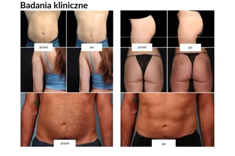 Badania kliniczne pokazują spektakularne trening ems efekty przed i po: szczuplejsze ciało, płaski brzuch i jędrniejsze pośladki.