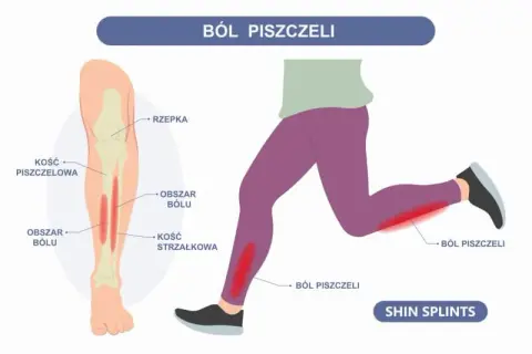 Ból goleni przy bieganiu: Twój przewodnik do biegania bez bólu