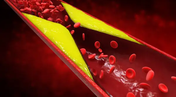Złogi cholesterolu zwężają naczynie krwionośne, utrudniając przepływ krwi. Wysoki poziom homocysteiny może pogarszać ten stan.