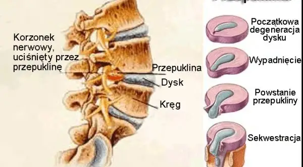 Przepuklina lędźwiowa: Jakie ćwiczenia pomogą, a czego unikać?