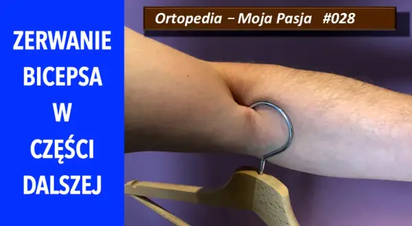 Zerwanie bicepsa w części dalszej. Widoczny hak wbit w mięsień, symbolizujący uraz.