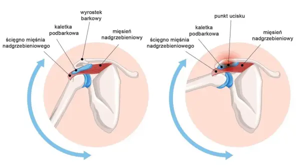 Anatomia barku: ścięgno mięśnia nadgrzebieniowego, kaletka podbarkowa i wyrostek barkowy. Po prawej widoczny punkt ucisku. Przedramię jest częścią kończyny górnej.