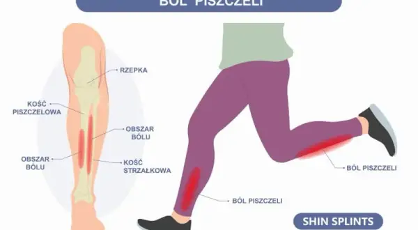 Ból goleni przy bieganiu: Twój przewodnik do biegania bez bólu
