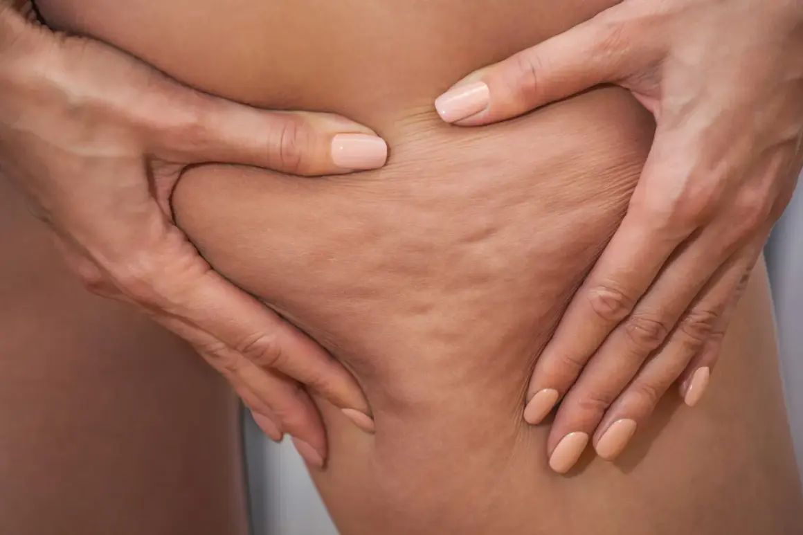 Dłonie ściskają skórę na udzie, ukazując cellulit. Szukasz sposobu, jak się pozbyć cellulitu?