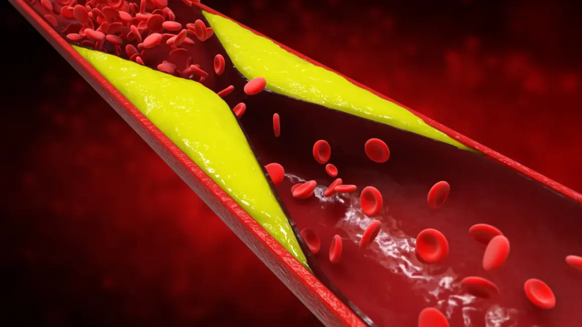 Złogi cholesterolu zwężają naczynie krwionośne, utrudniając przepływ krwi. Wysoki poziom homocysteiny może pogarszać ten stan.