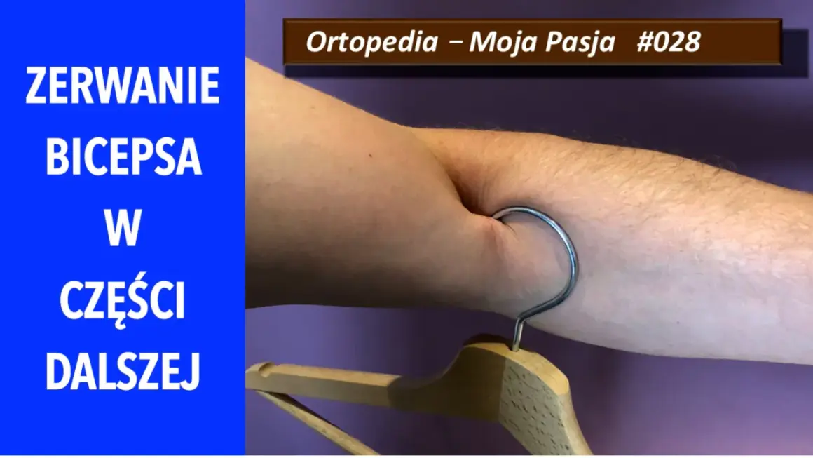 Zerwanie bicepsa w części dalszej. Widoczny hak wbit w mięsień, symbolizujący uraz.