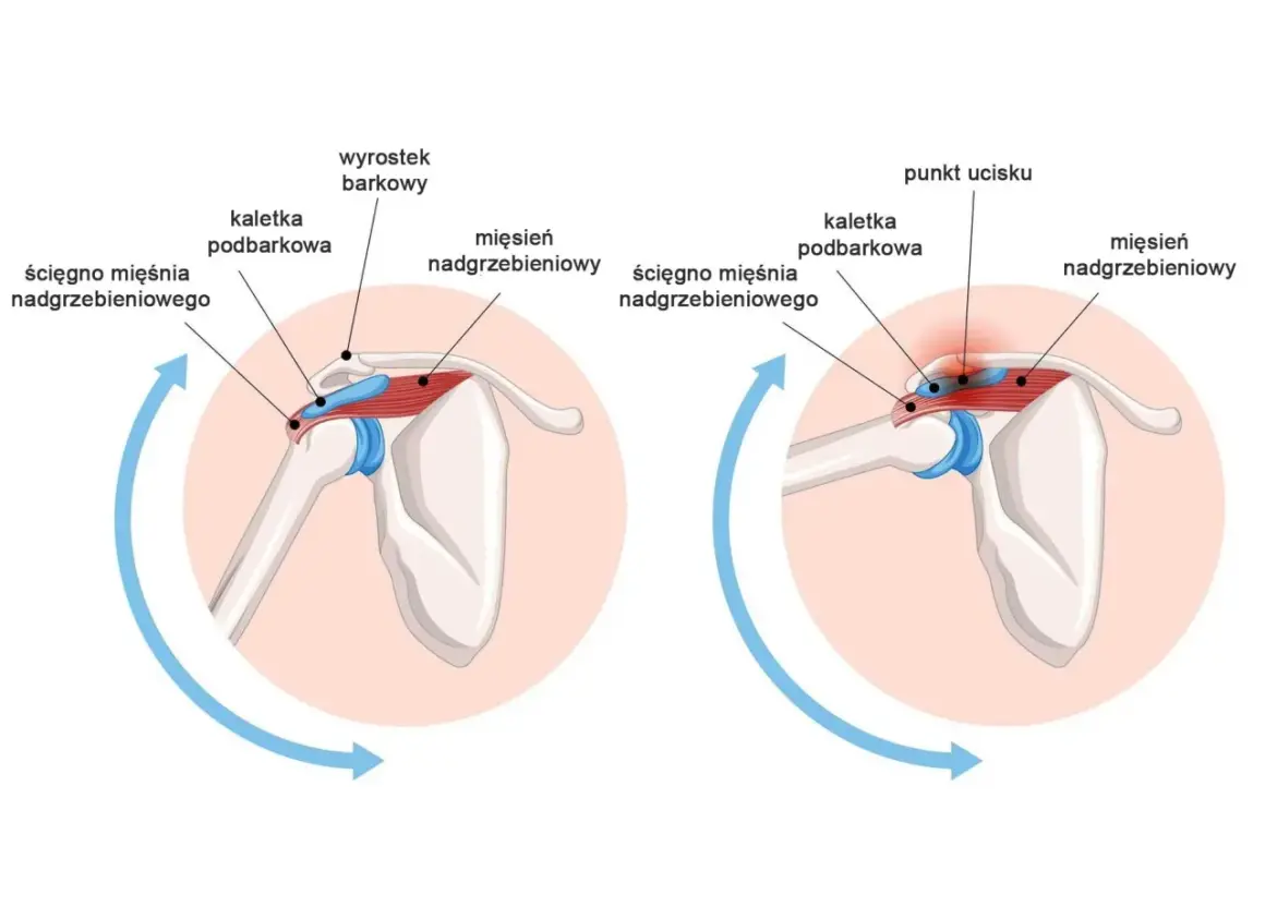 Anatomia barku: ścięgno mięśnia nadgrzebieniowego, kaletka podbarkowa i wyrostek barkowy. Po prawej widoczny punkt ucisku. Przedramię jest częścią kończyny górnej.