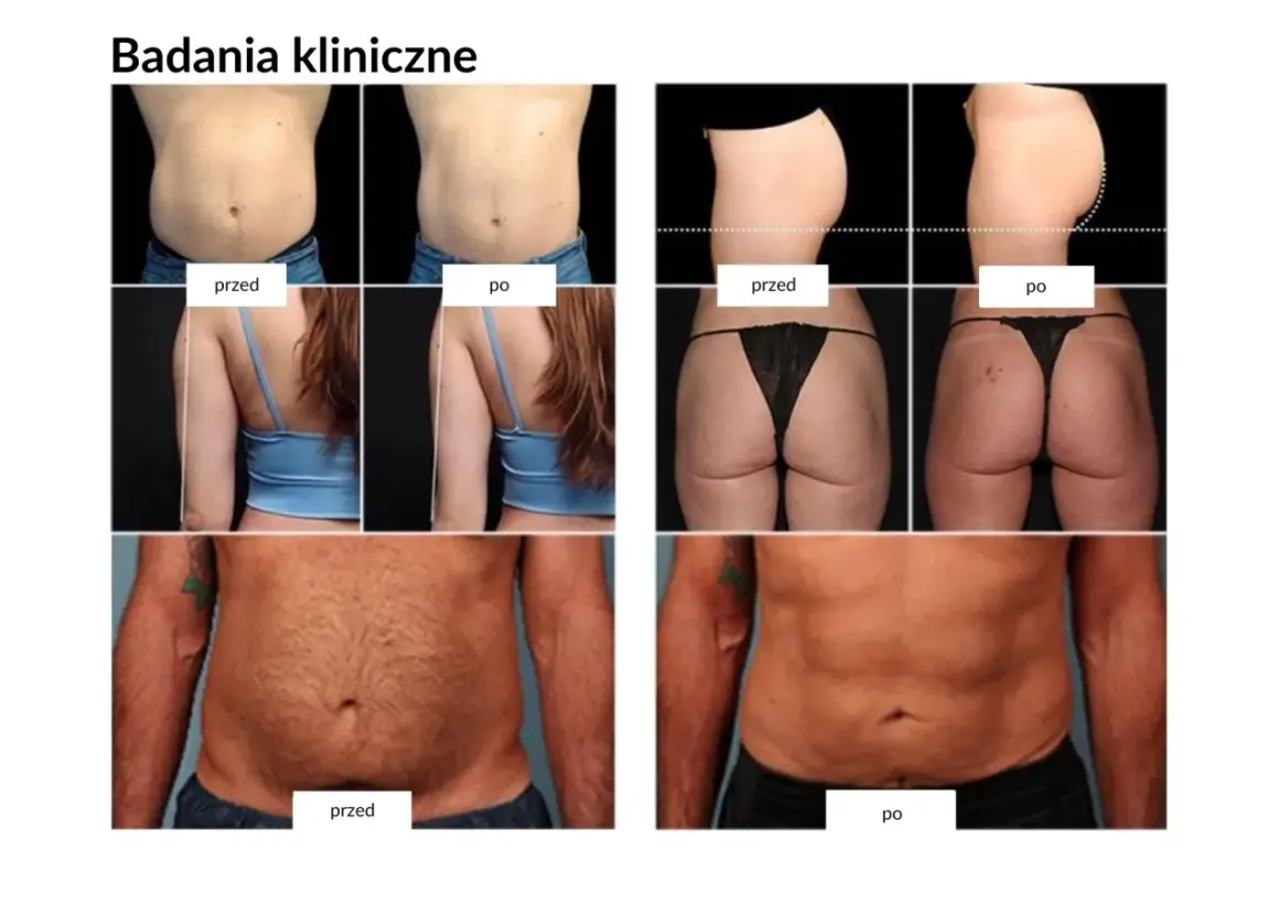 Badania kliniczne pokazują spektakularne trening ems efekty przed i po: szczuplejsze ciało, płaski brzuch i jędrniejsze pośladki.