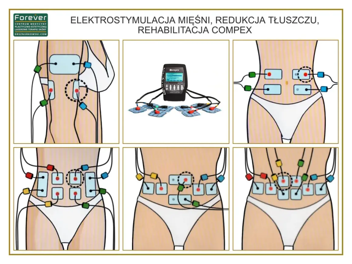 Elektrostymulacja mięśni brzucha i talii z użyciem elektrod Compex. Idealne dla mezomorfika chcącego wyrzeźbić sylwetkę.
