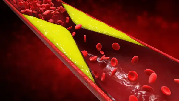 Złogi cholesterolu zwężają naczynie krwionośne, utrudniając przepływ krwi. Wysoki poziom homocysteiny może pogarszać ten stan.