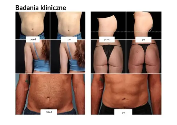 Badania kliniczne pokazują spektakularne trening ems efekty przed i po: szczuplejsze ciało, płaski brzuch i jędrniejsze pośladki.