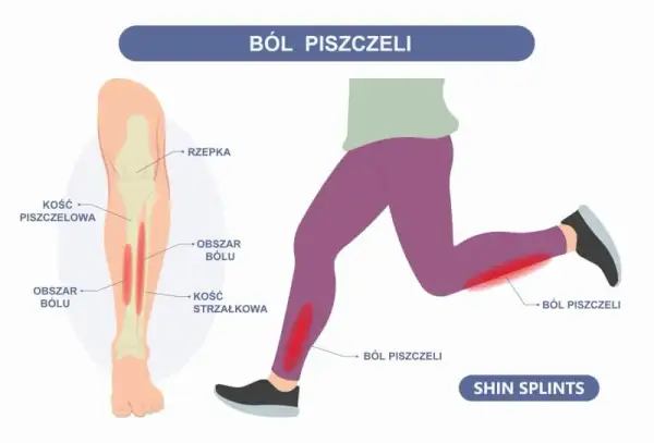 Ból goleni przy bieganiu: Twój przewodnik do biegania bez bólu